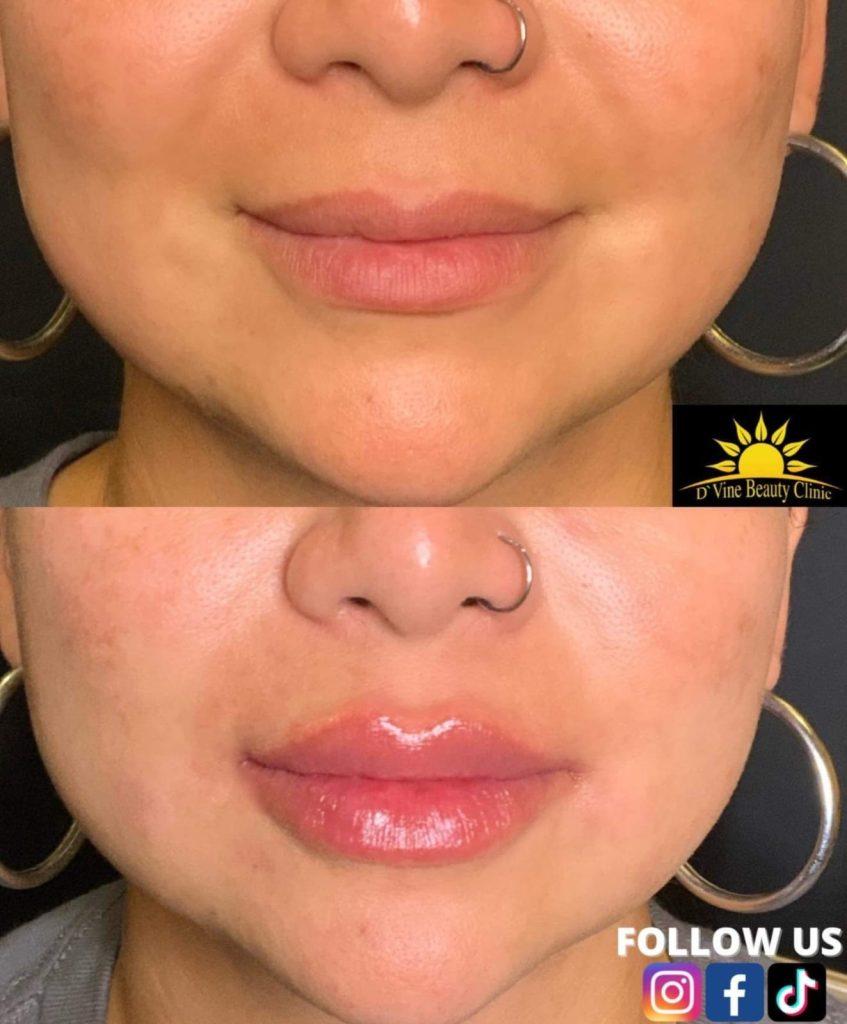 Chelsey Perez, FNP-C on Instagram: Protect your investment! Using straws  and smoking can cause migration and indents in your lip filler. Be honest  with your injector if you do smoke or use
